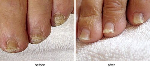 clearsteps before and after