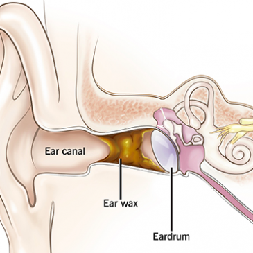 Earwax Build up and Blockage